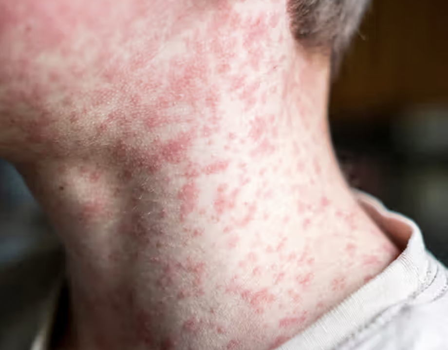 Adams County Measles Case Reported As Indiana Total Reaches 16